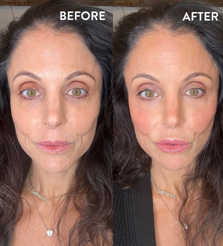 Bethenny Frankel before and after