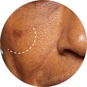 PLP Category Icon - Dark Spots