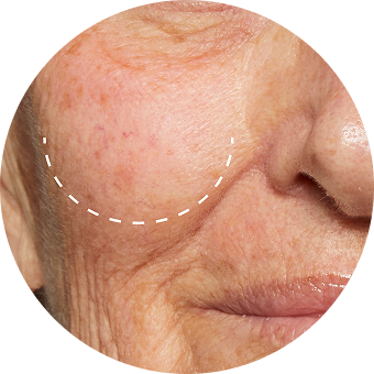 PLP Category Icon - Redness